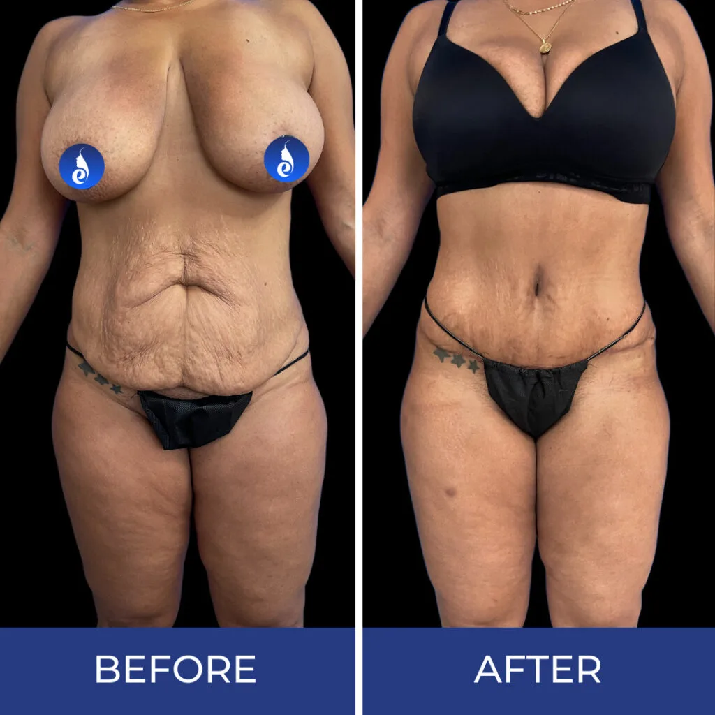 Before and after body sculpting results showing abdominal and torso contouring with tightened skin