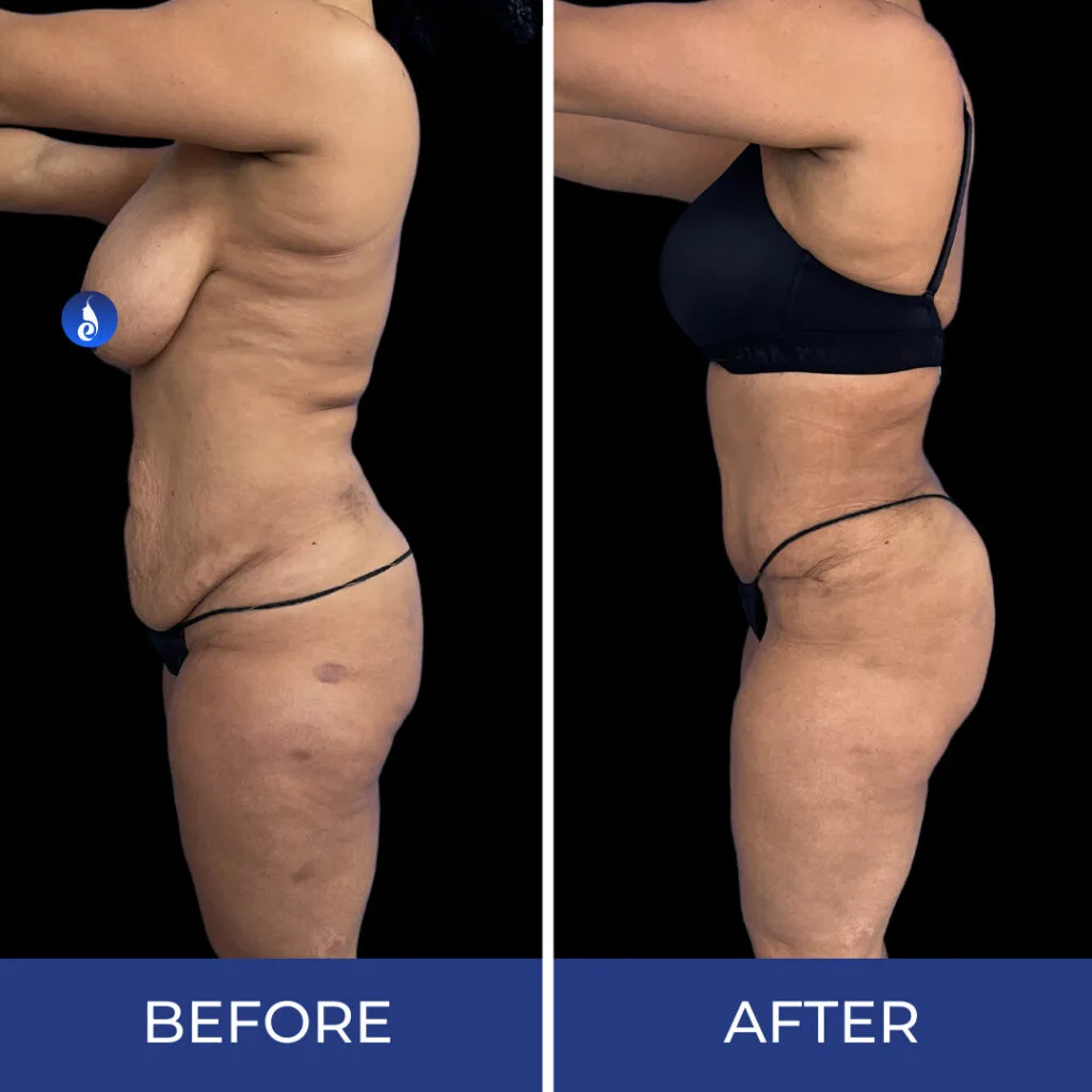 Before and after body sculpting results showing buttock and torso contouring from side profile