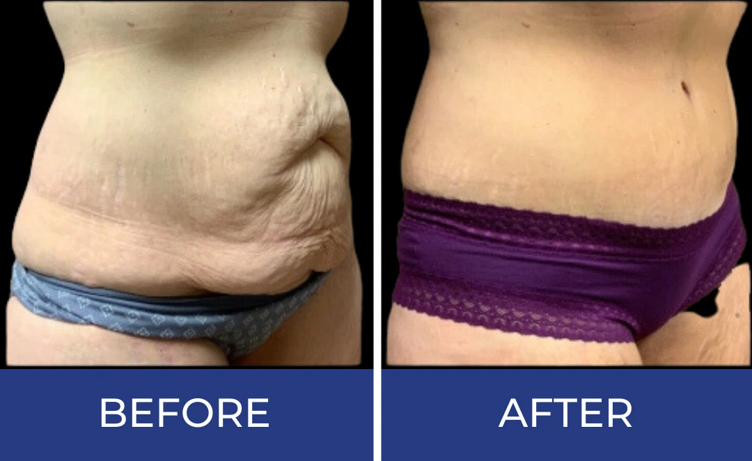 Before and after body sculpting treatment showing reduced skin laxity and improved abdominal contour