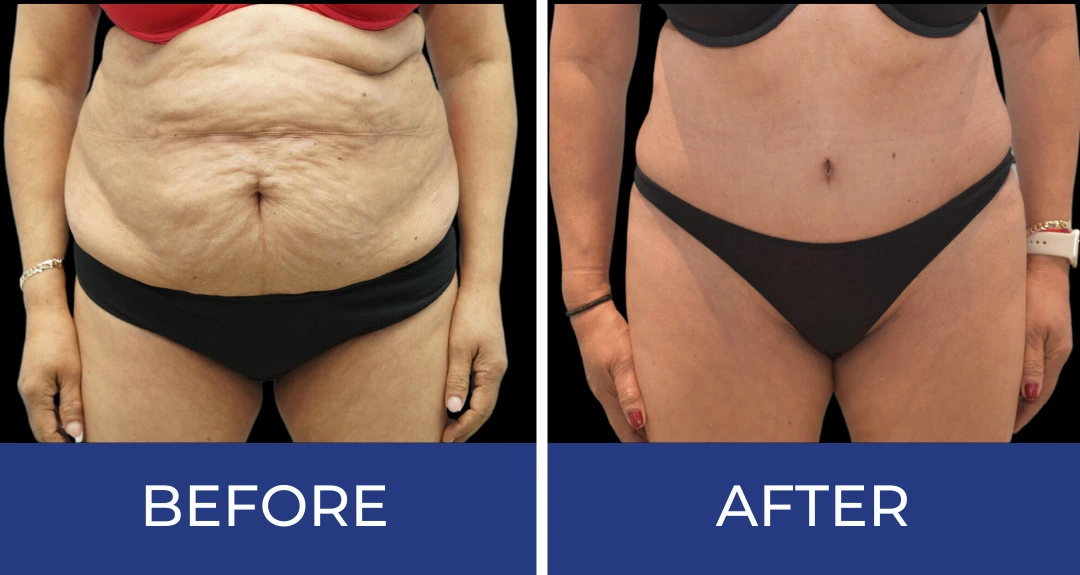 Before and after body sculpting treatment showing reduced abdominal skin excess and improved definition