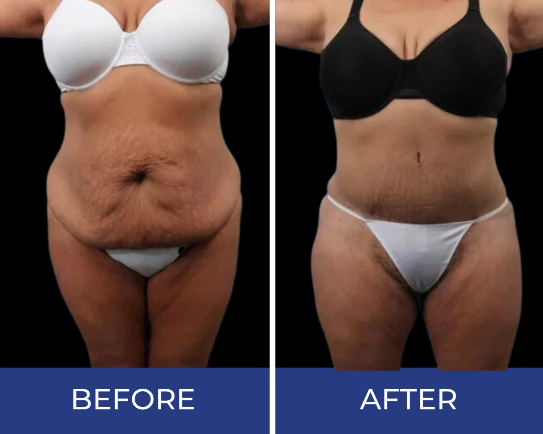 Before and after comparison showing abdominal and torso body sculpting results