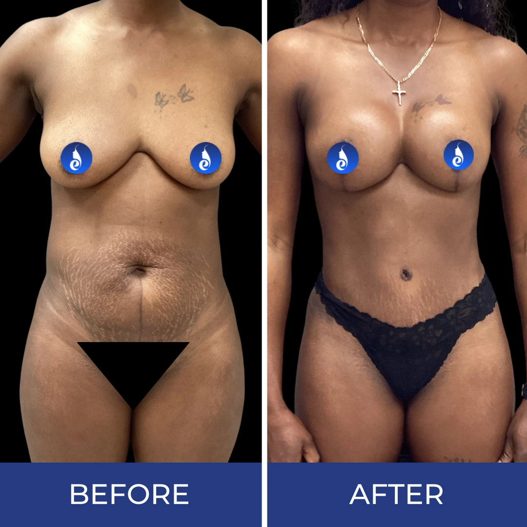 Before and after body sculpting results showing frontal torso and torso view