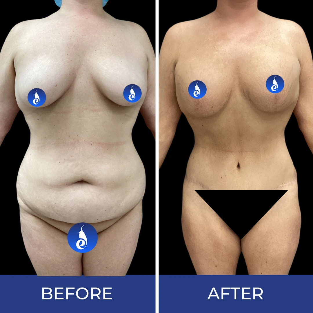 Before and after body sculpting results showing frontal torso and full body view