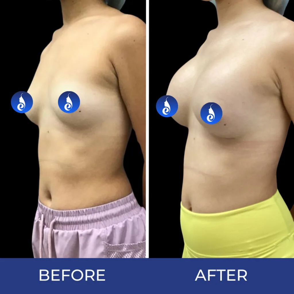 Before and after front torso comparison showing chest enhancement results