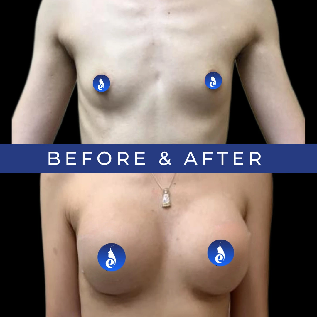 Before and after frontal breast augmentation comparison with Exert logo overlays