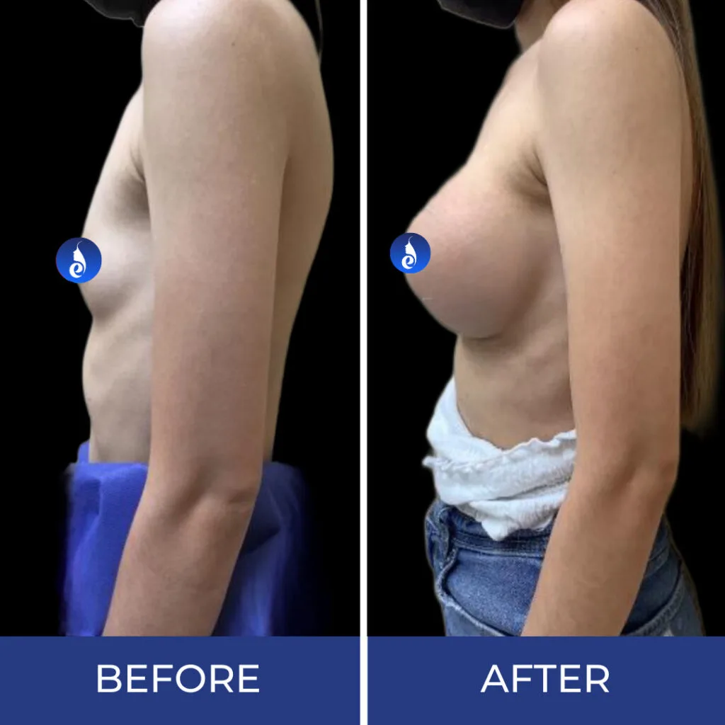 Before and after side profile comparison showing breast augmentation results