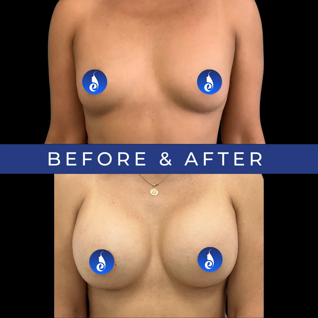 Breast augmentation before and after comparison, frontal view