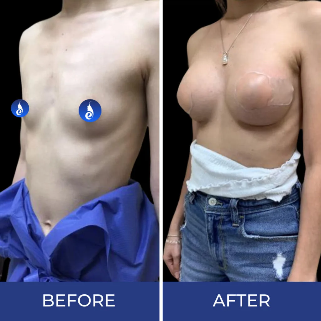 Before and after front view comparison showing breast augmentation results