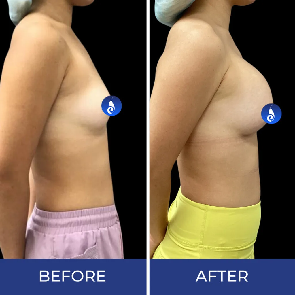 Before and after side profile comparison showing chest enhancement results