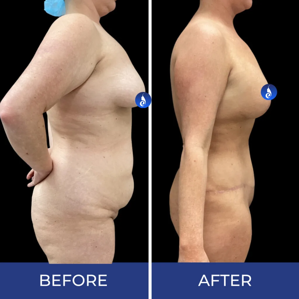 Before and after body sculpting results showing side and back view