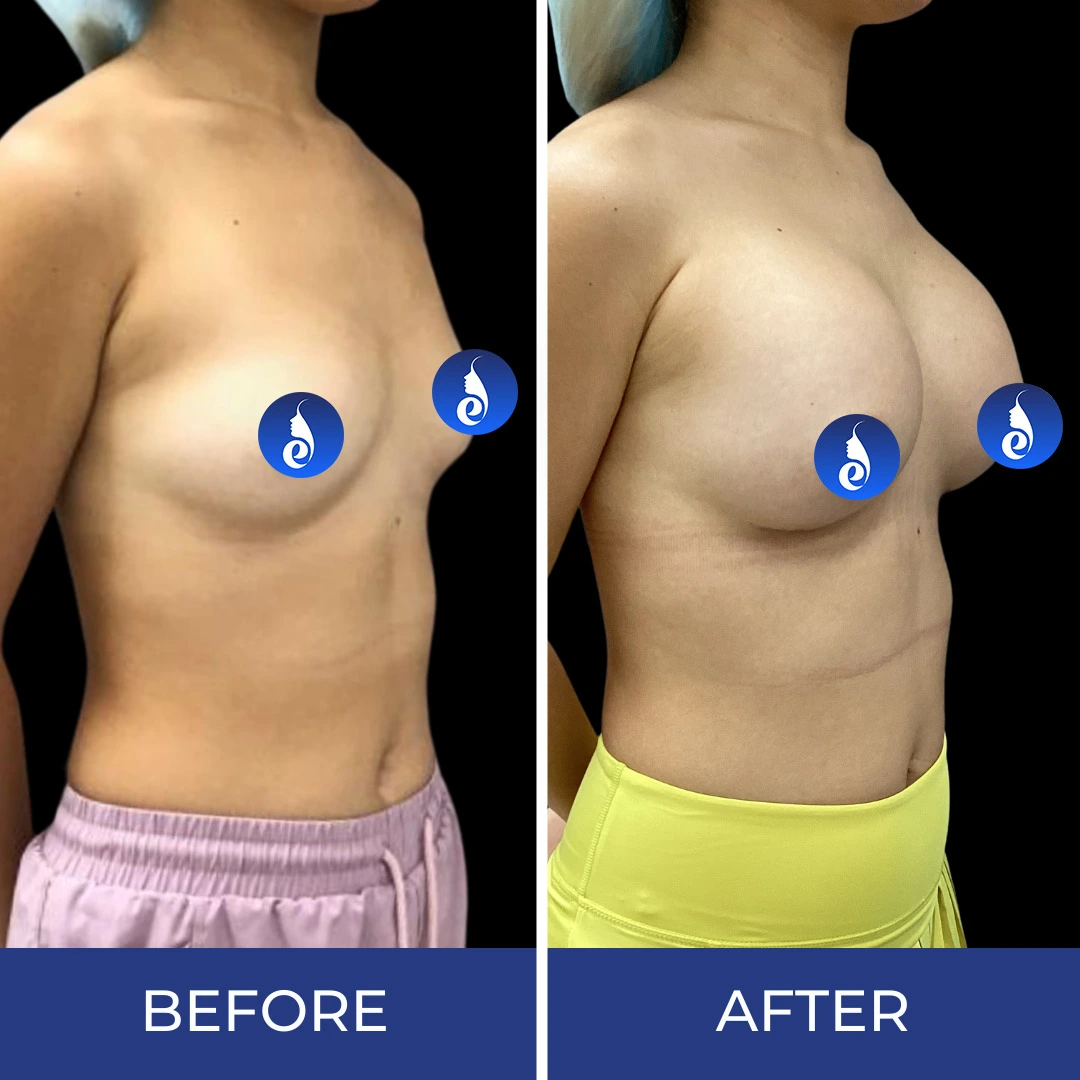 Before and after angled torso comparison showing bilateral chest enhancement