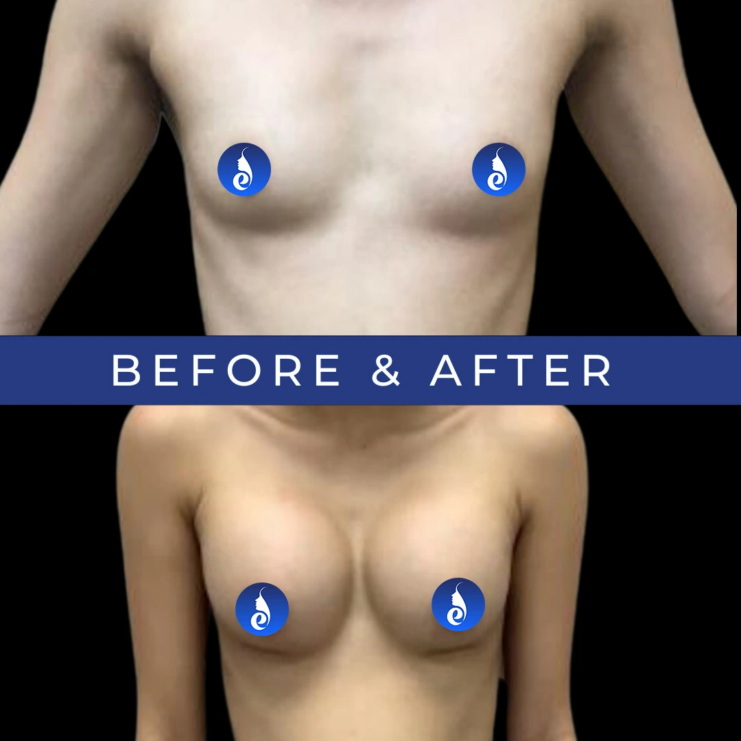Before and after breast augmentation comparison showing frontal view
