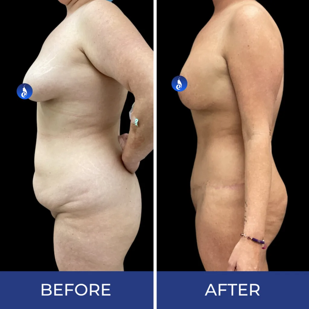 Before and after body sculpting results showing side profile view