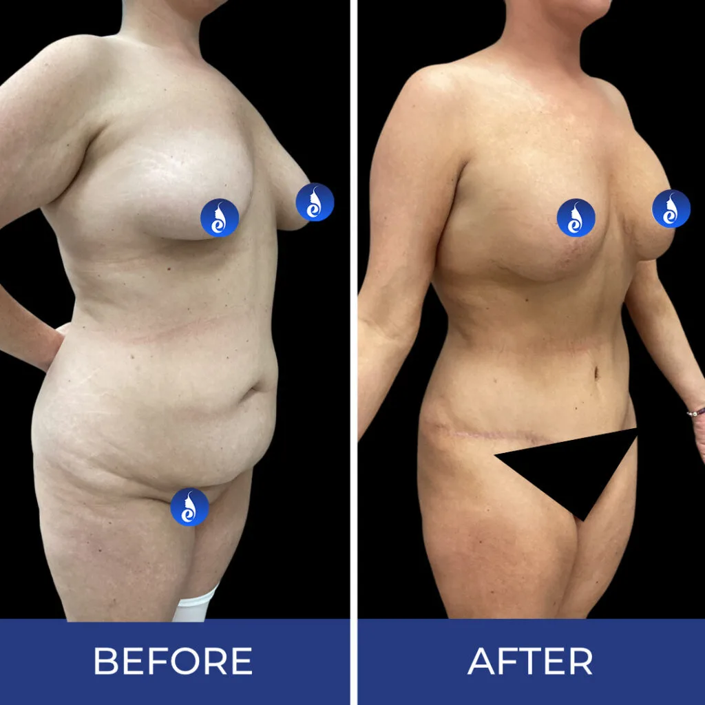 Before and after body sculpting results showing frontal torso and side profile view