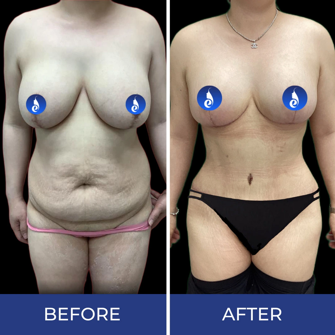 Before and after body sculpting results showing frontal torso view
