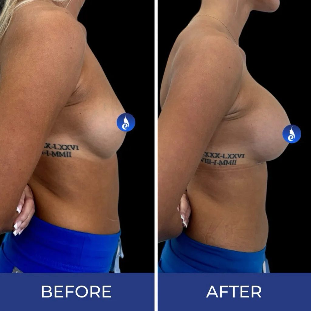 Before and after side profile comparison showing breast augmentation results