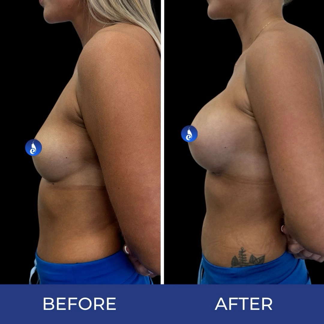 Before and after side profile comparison showing breast augmentation results