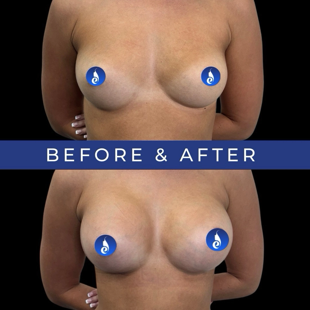 Before and after front view comparison showing breast augmentation results