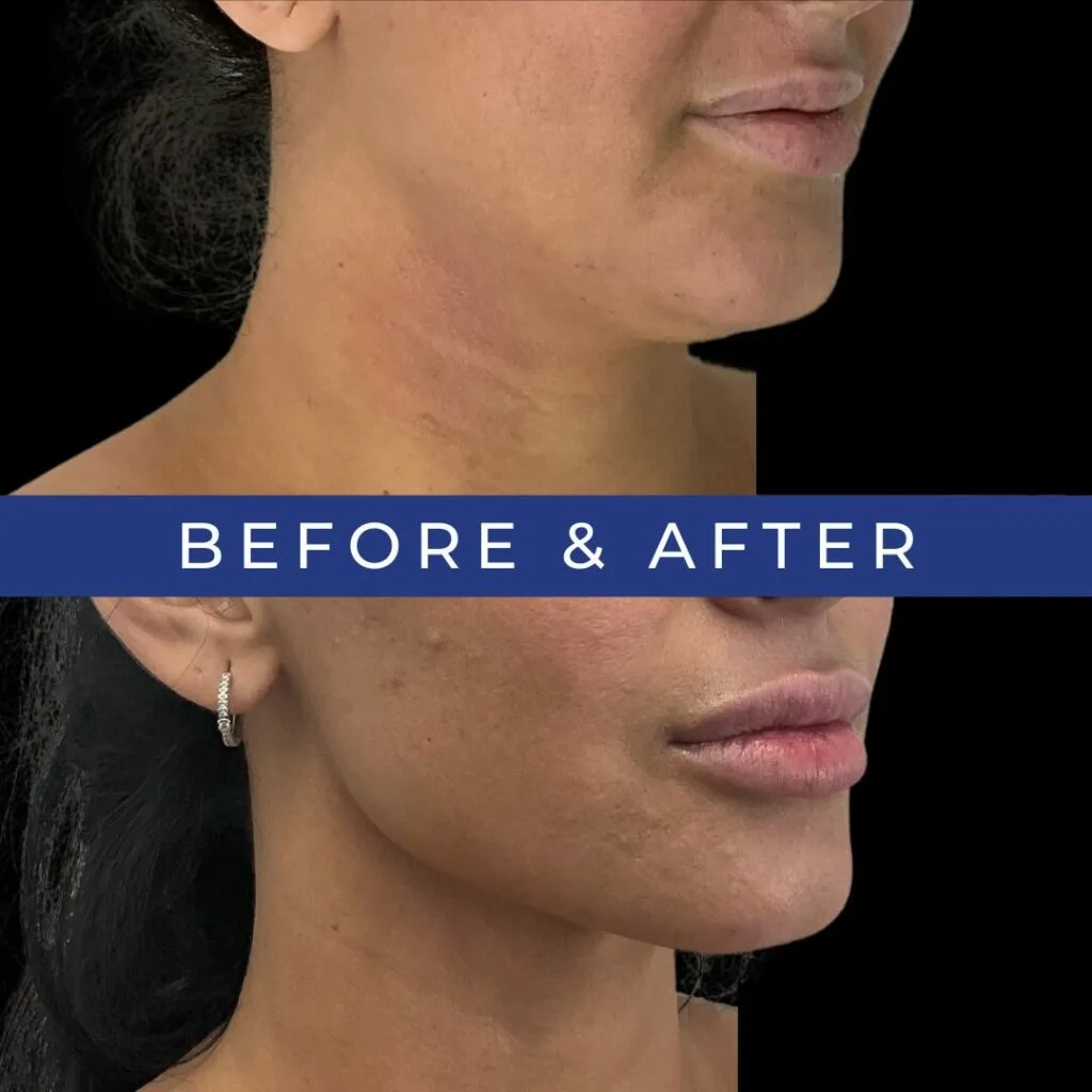 Before and after side profile showing chin and jawline definition