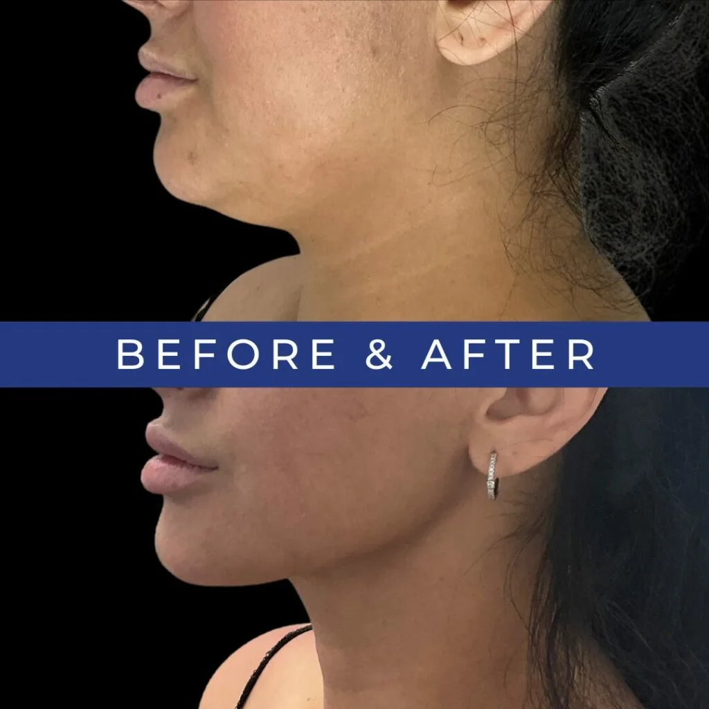 Before and after side profile showing chin and neck definition