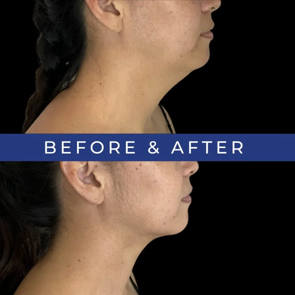Before and after side profile showing improved chin definition and jawline sharpness