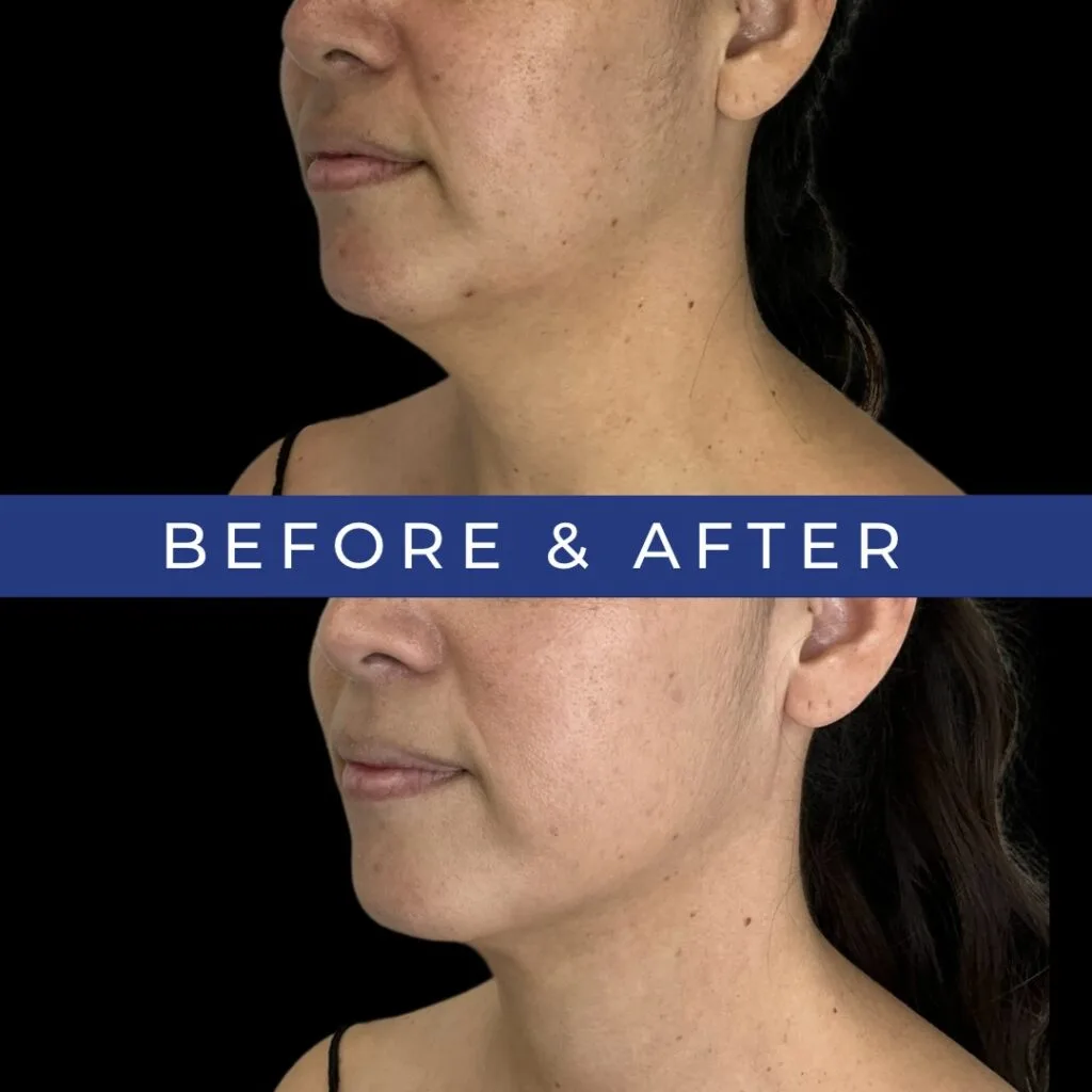 Before and after side profile showing more defined chin and improved facial contour