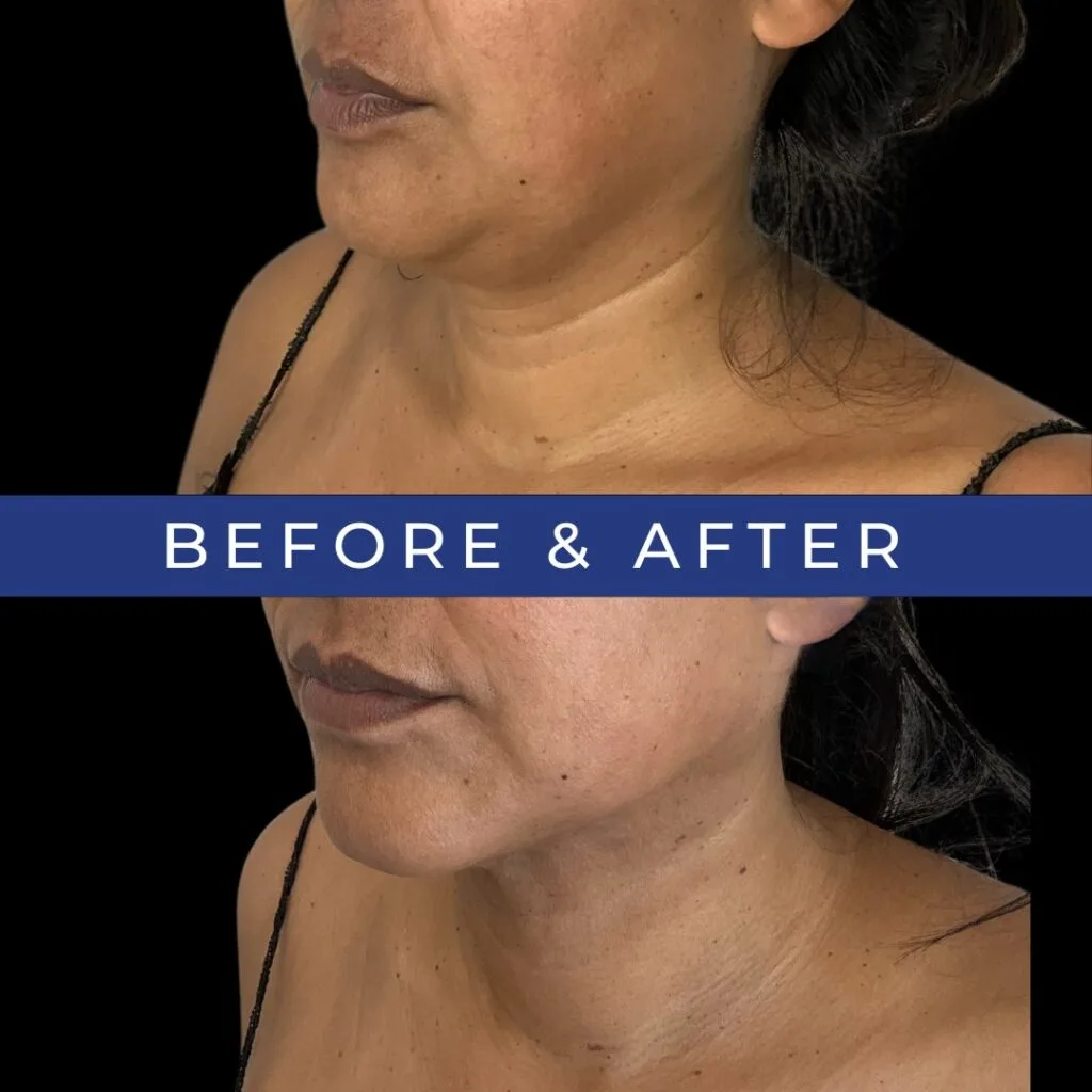 Female patient showing jawline and neck before and after treatment with reduced sagging