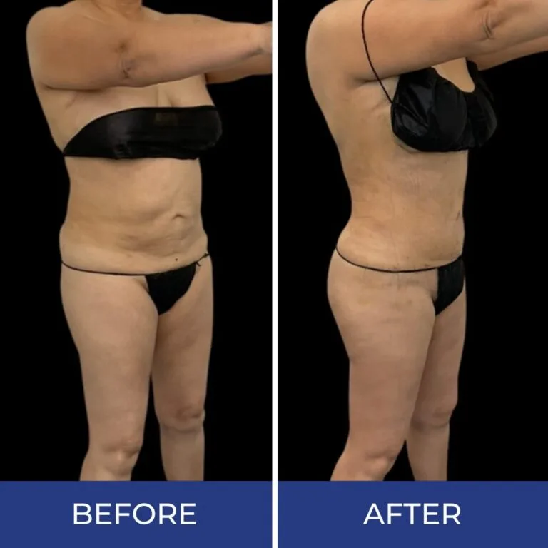 Before and after side view showing arm and torso body sculpting results
