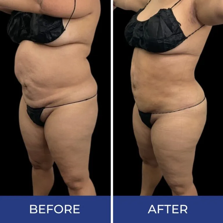Before and after body sculpting results showing reduced abdominal and flank fullness from side view