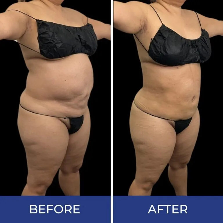 Before and after body sculpting results showing reduced abdominal fullness and improved waistline from front view