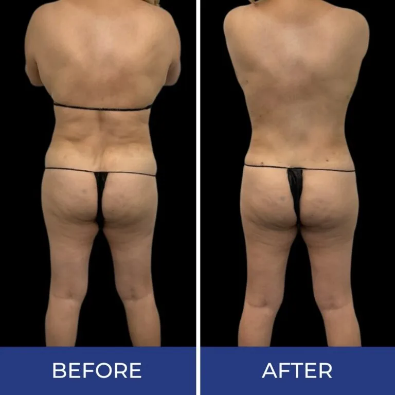 Before and after rear view showing back and lower body body sculpting results