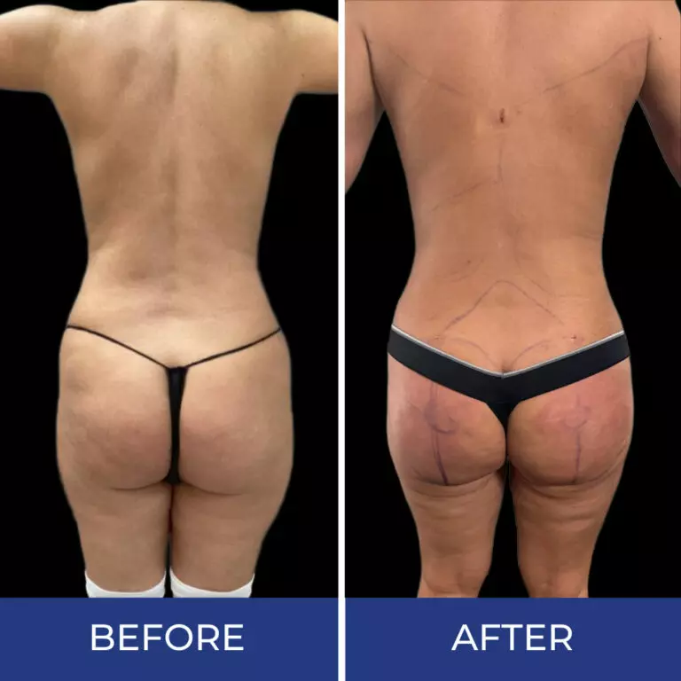 Back view before and after body sculpting treatment showing improved waist definition and skin texture