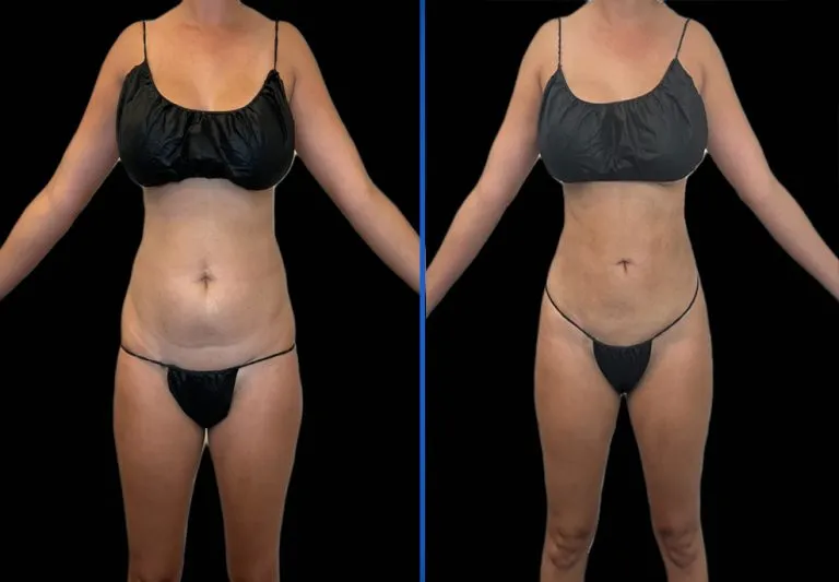 Front-facing full body before and after comparison of torso and lower body results