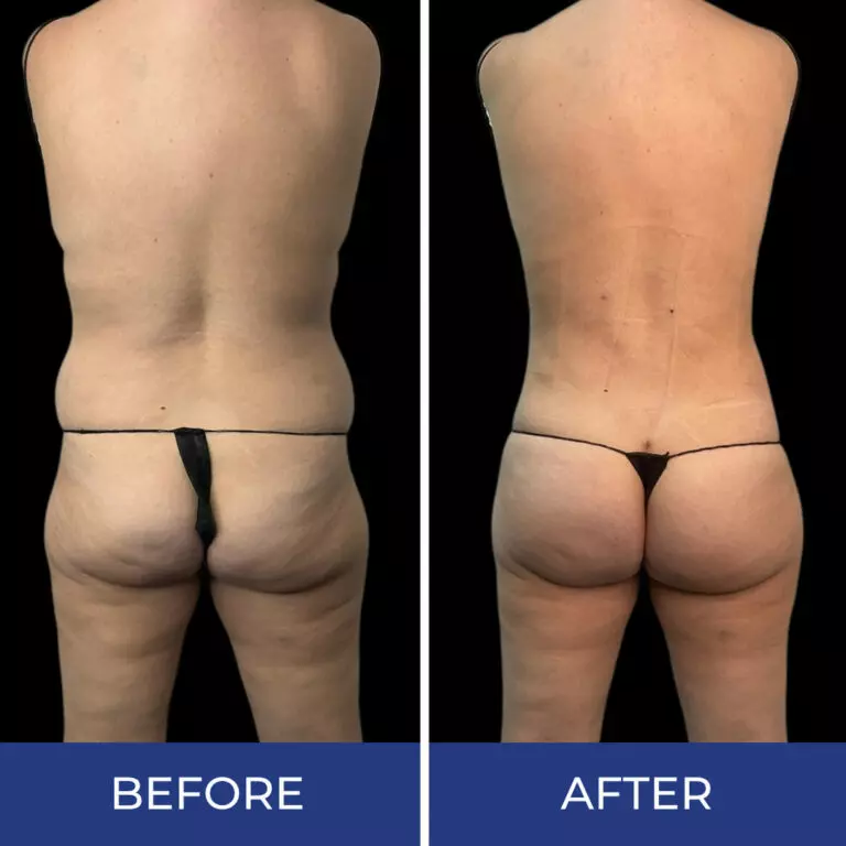 Before and after rear view comparison showing gluteal enhancement and body contouring results