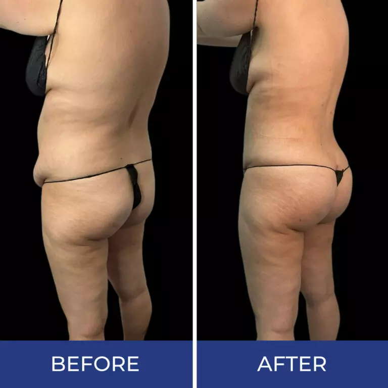Before and after side profile of buttock lift and body sculpting results