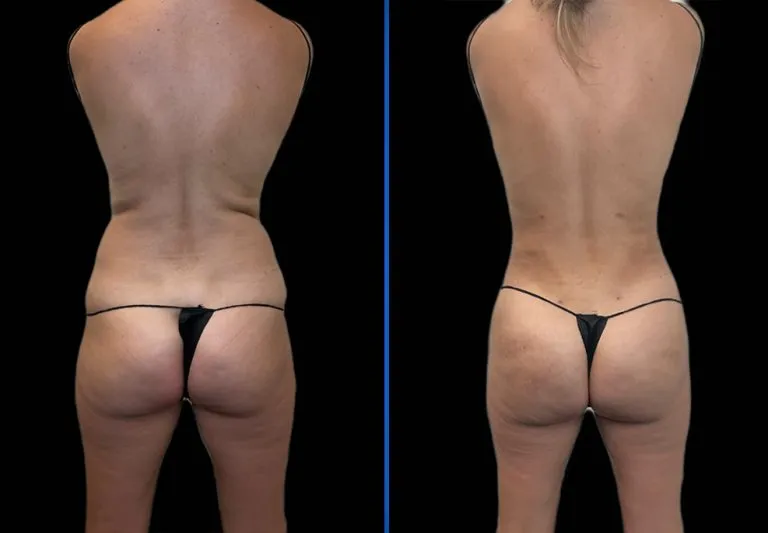 Before and after rear view showing buttock enhancement results