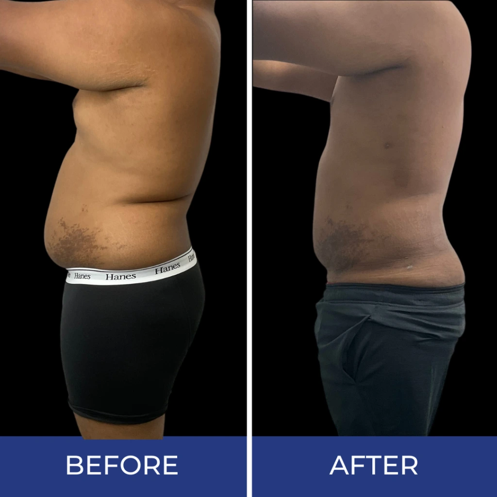 Side-by-side before and after comparison showing reduced abdominal protrusion