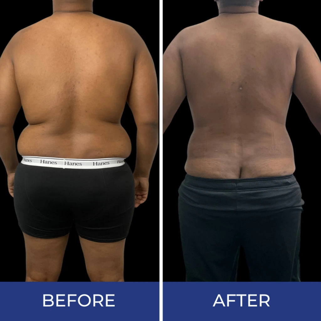 Before and after back view showing reduced love handles and overall back contouring
