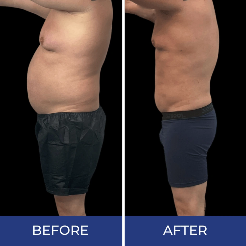 Side-by-side before and after comparison showing reduced midsection bulge