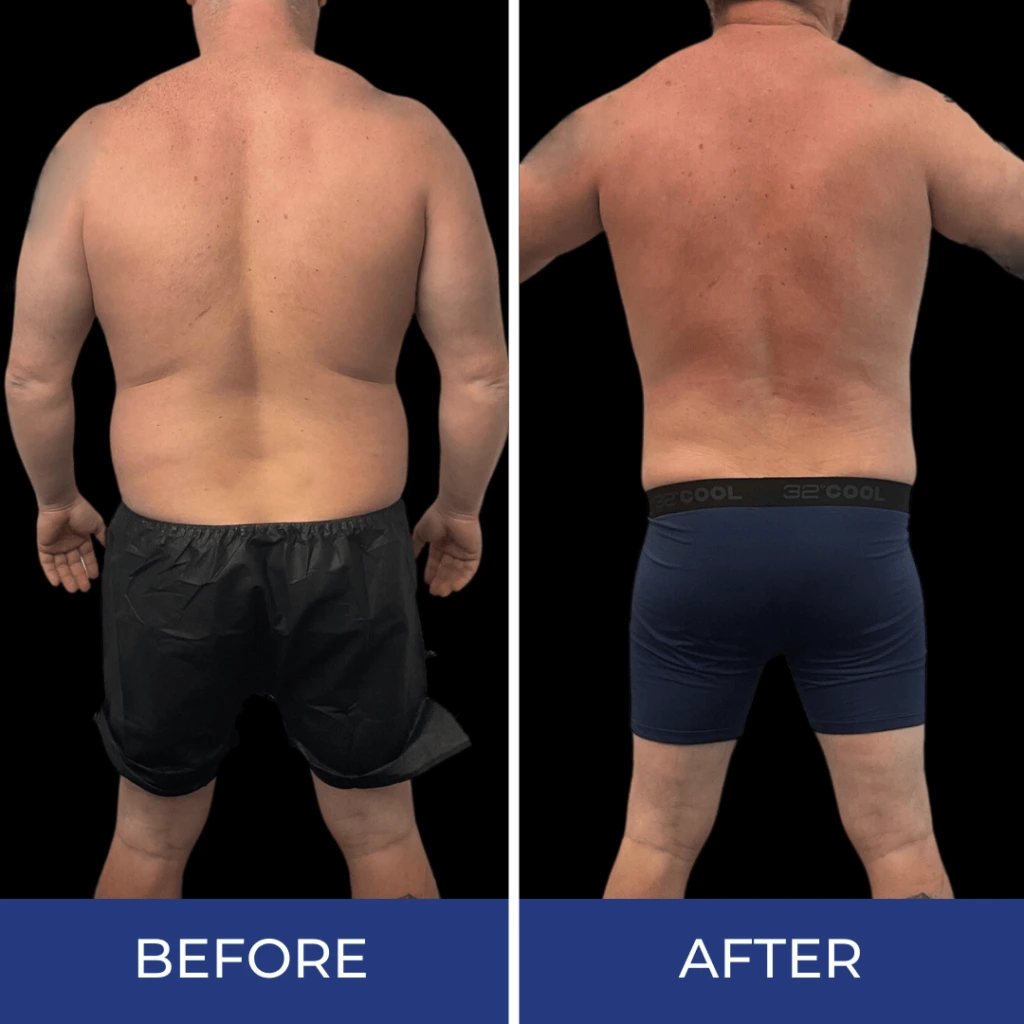 Before and after back view of male torso showing reduced back and flank fat