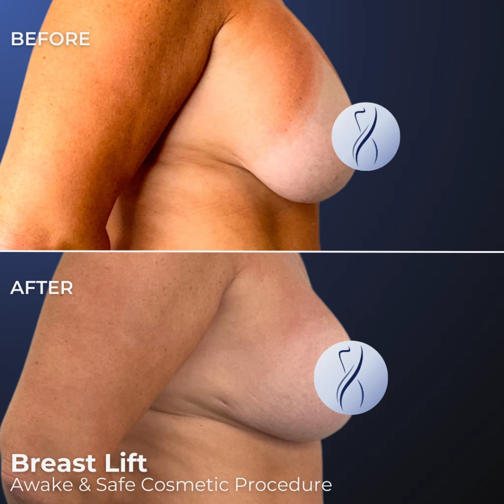 Before and after side view of breast lift results