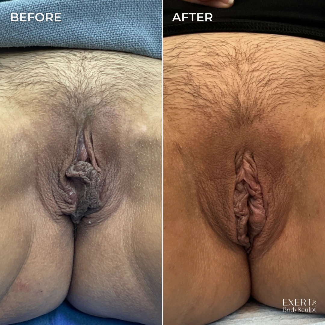 Before and after labiaplasty results showing refined labial contours