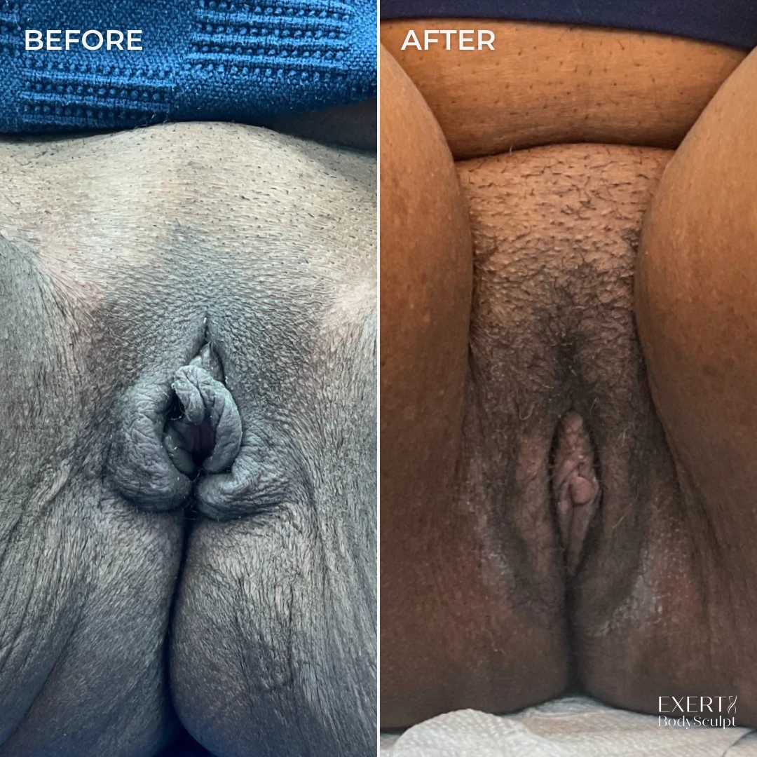 Before and after labiaplasty results showing reduced labial prominence