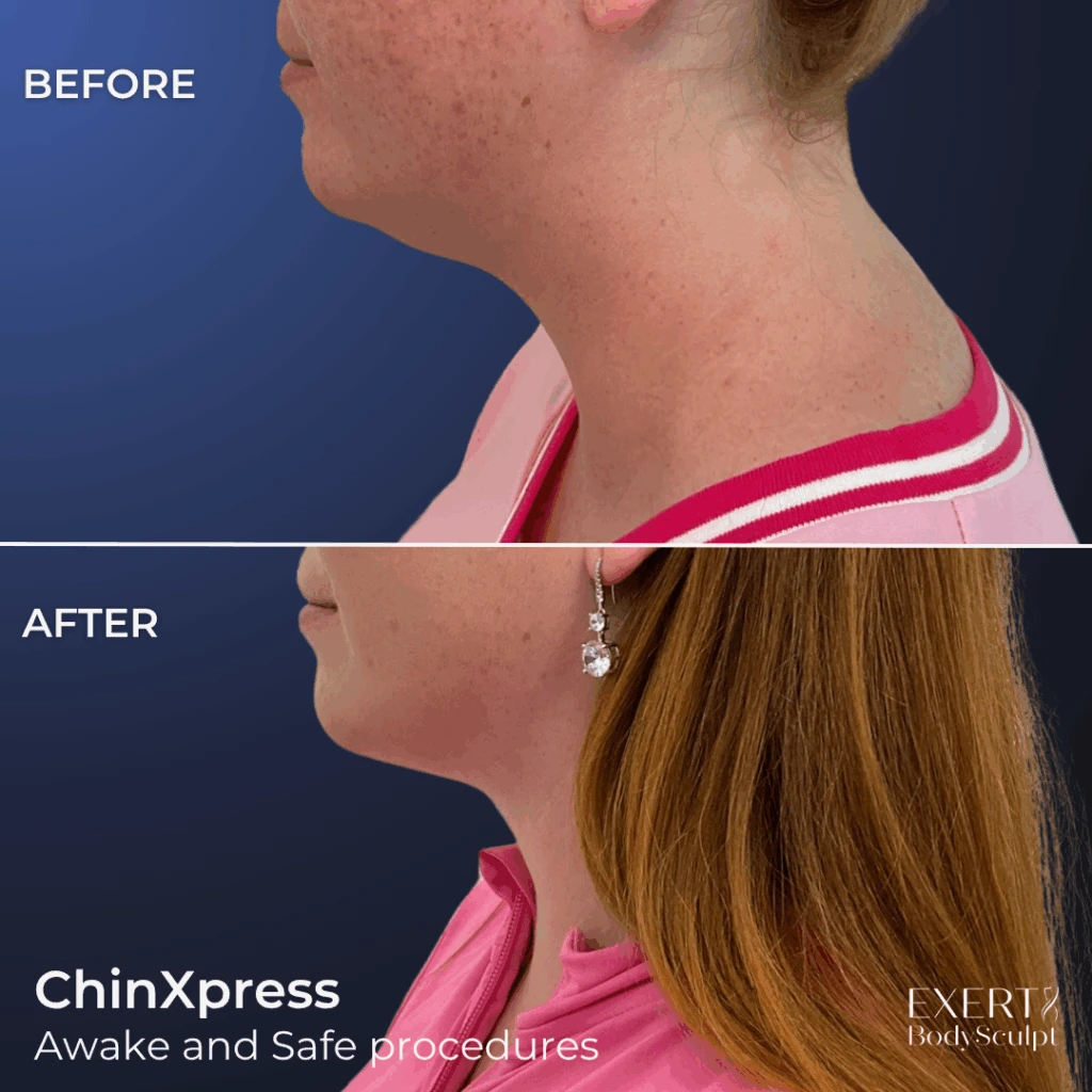 Before and after ChinXpress procedure showing improved neck and jawline contour in side profile
