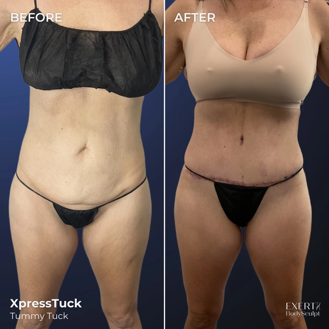 Before and after XpressTuck tummy tuck comparison showing torso front view