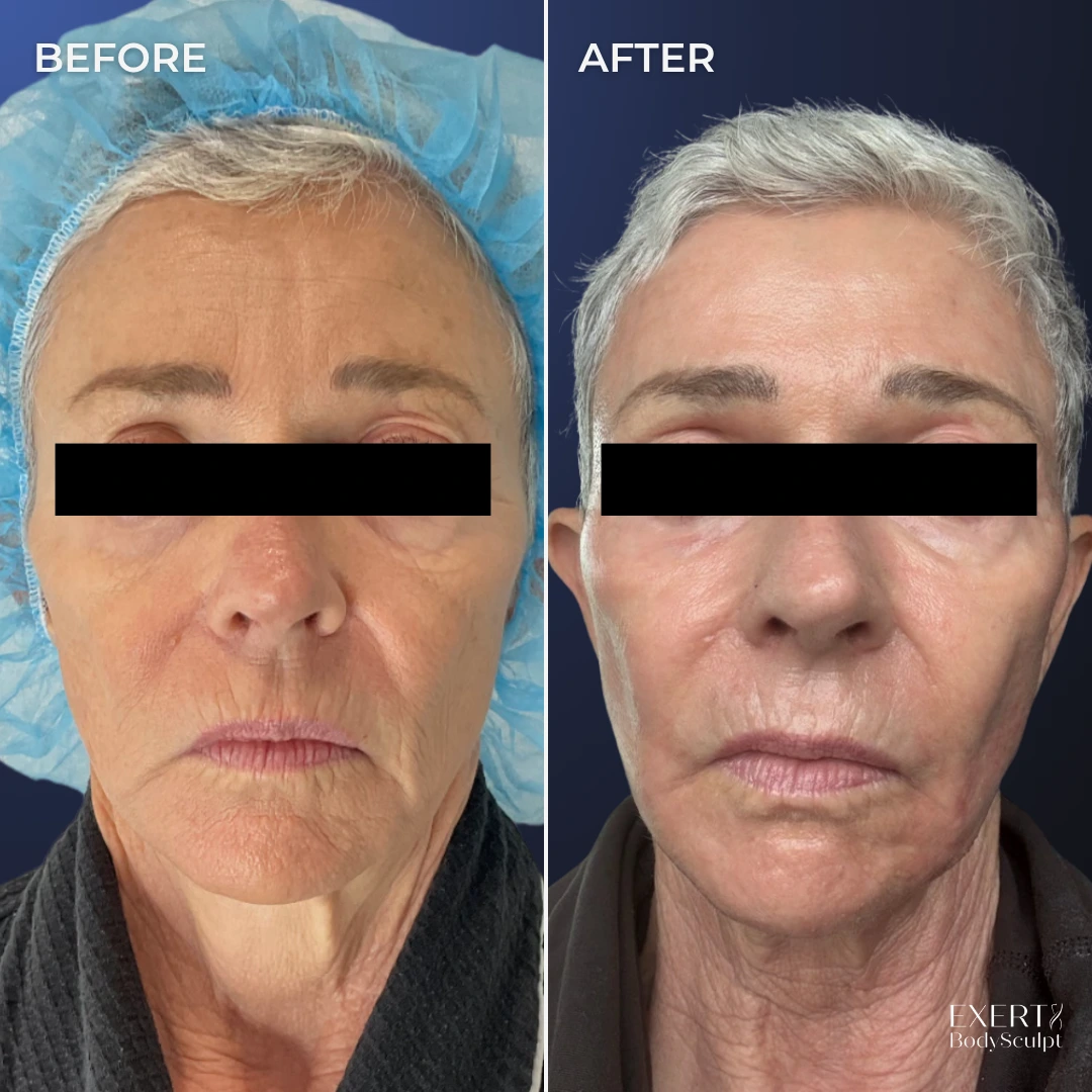 Before and after front-facing photos showing reduced forehead wrinkles and improved skin texture