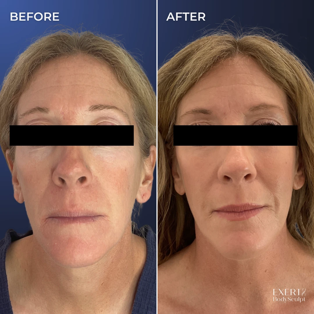 Before and after front-facing comparison showing smoother skin texture and reduced facial lines