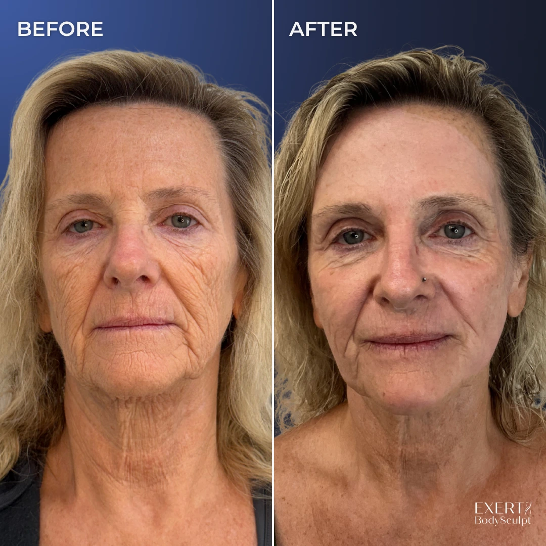 Before and after front-facing photos showing facial skin texture and wrinkle improvement
