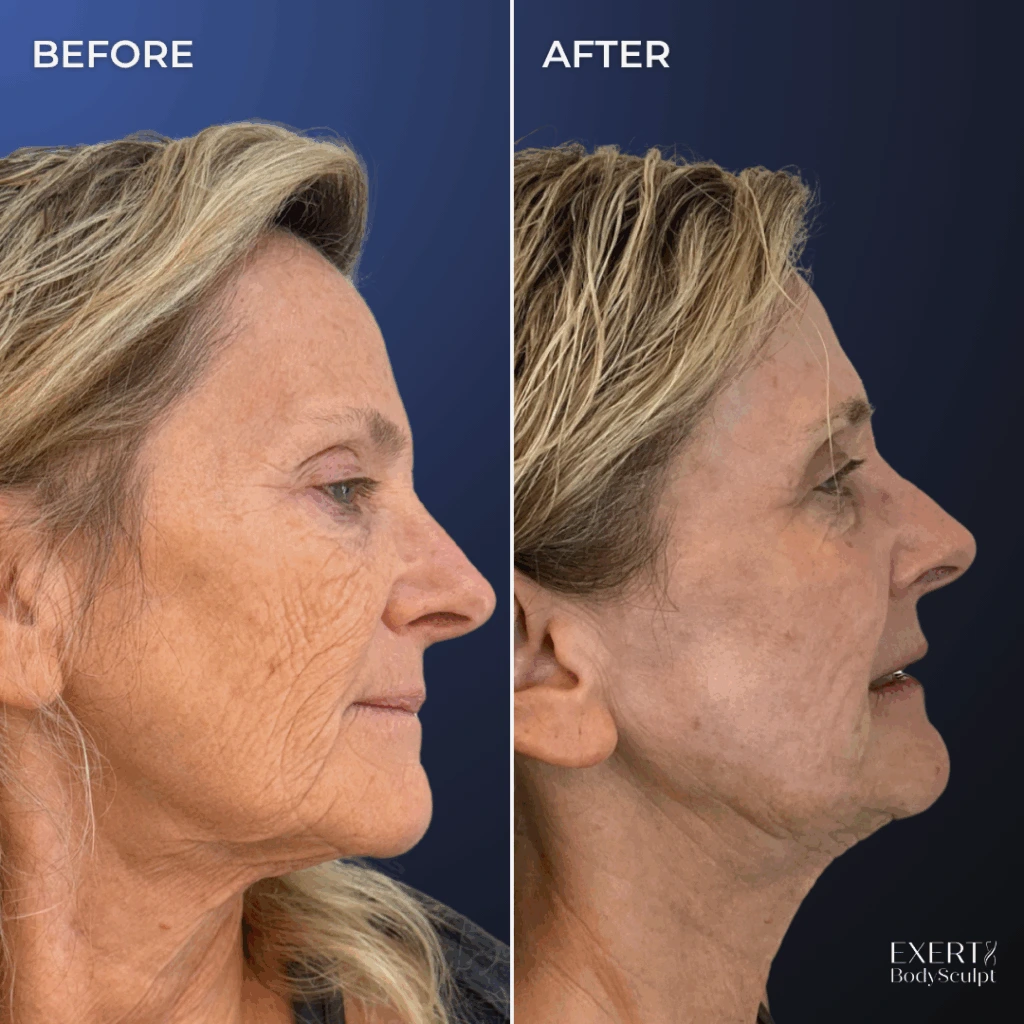 Before and after side profile photos showing improved skin elasticity and facial contours