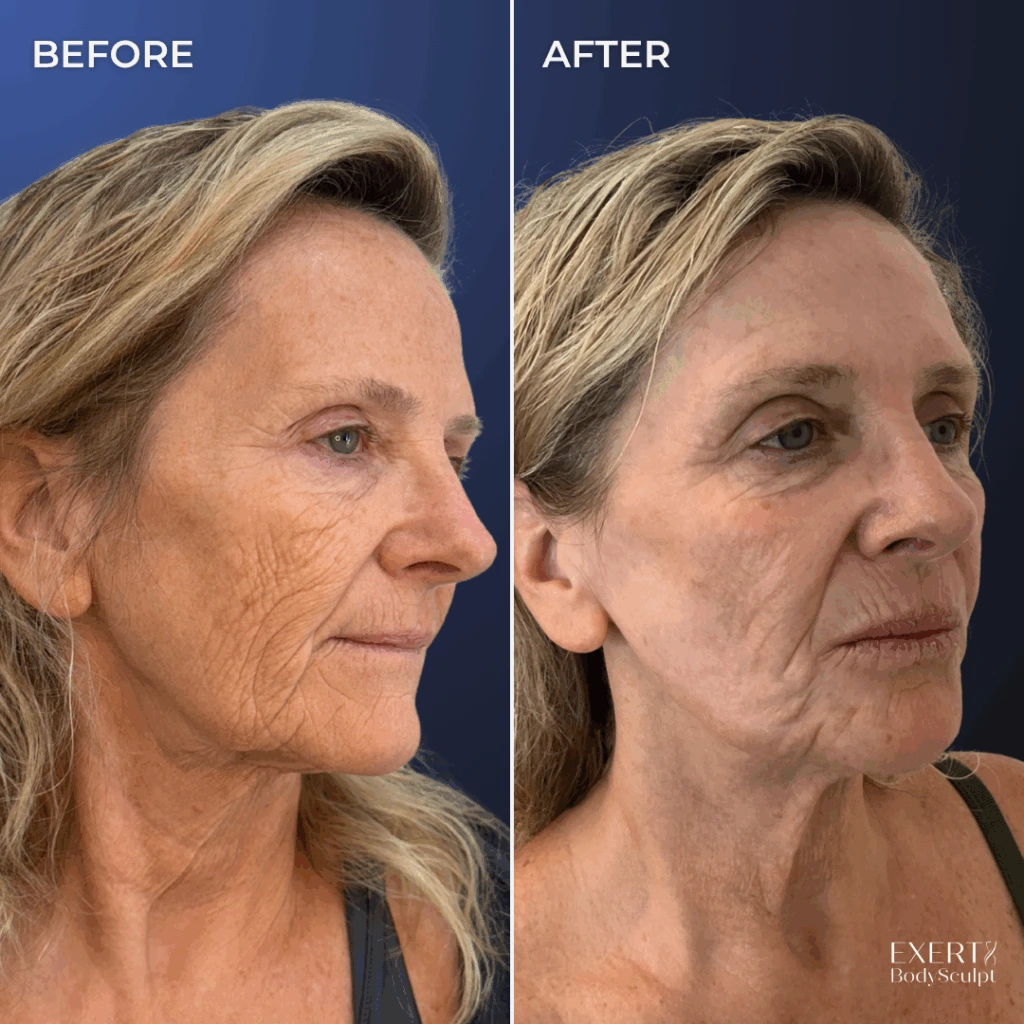 Before and after side profile photos showing facial skin quality and fine line improvement